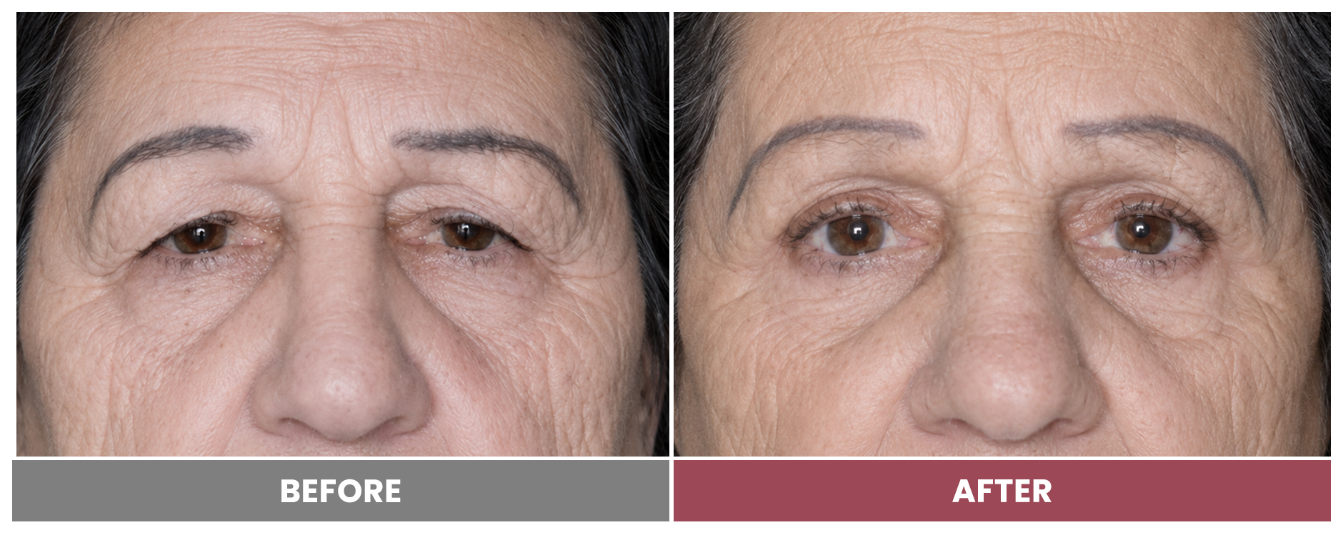 Upper Blepharoplasty - Case 71